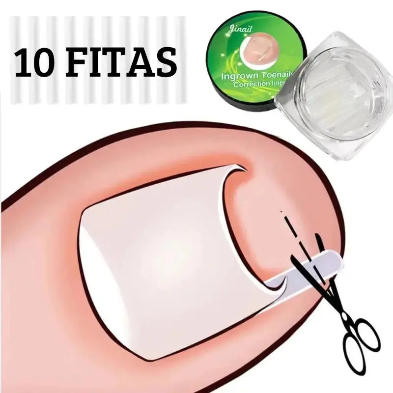 Fita Órtese Desencravar Unha Encravada Corretora 10 Peças AgoraFacilita