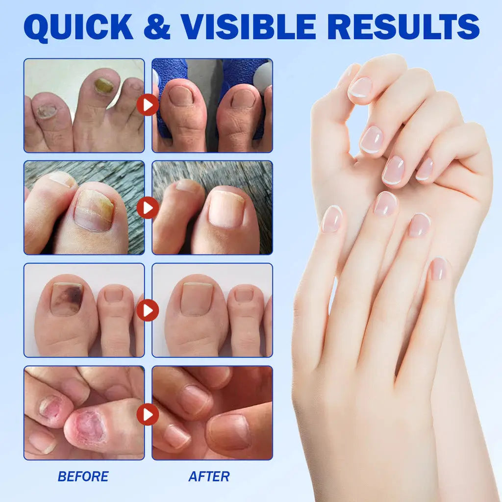 Patches De Fungos Para Unhas, 21 Pçs Pé Reparação De Unhas Remendo Cinza Correção Fúngica Adesivo AgoraFacilita