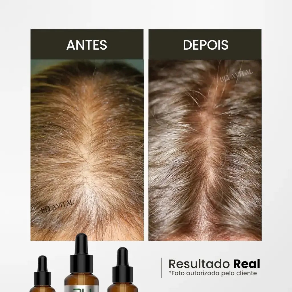 Óleo de Alecrim: Crescimento e Fortalecimento Capilar Bela Vital